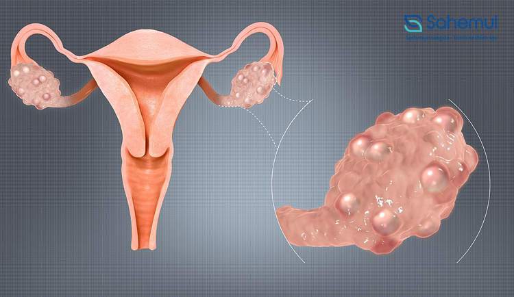 Hội chứng buồng trứng đa nang (PCOS) 1